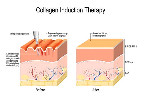 Collagen Induction Therapy