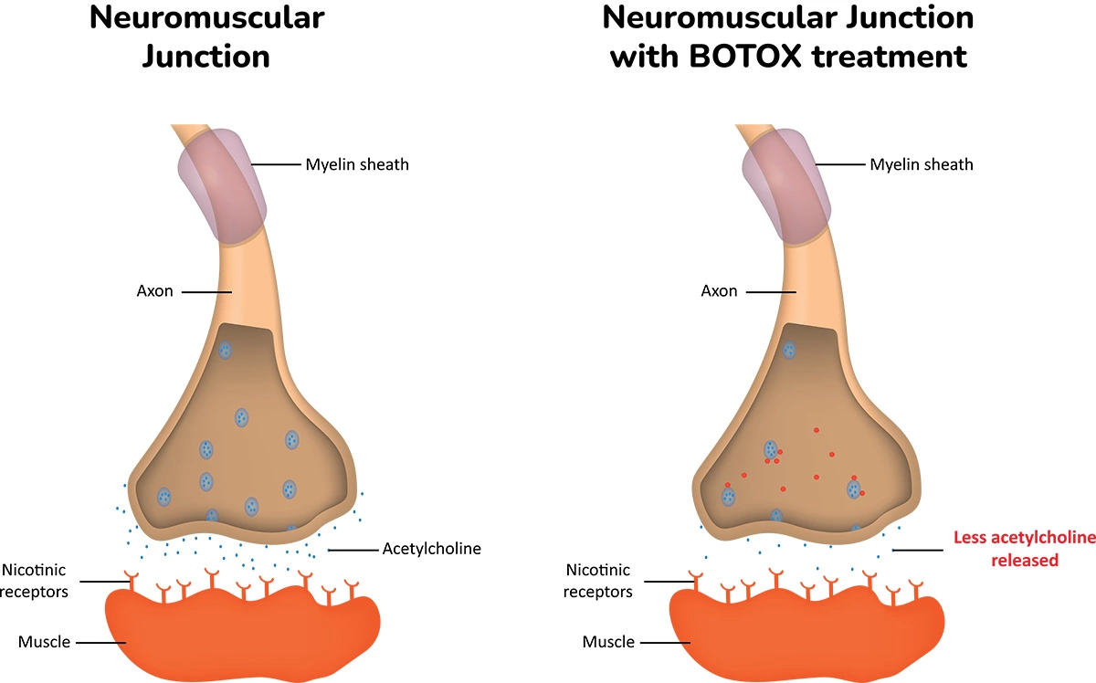 Infographic: How Botox Affects the Nerves & Muscles displays how botox injections affect nerve transmission to prevent muscle contraction. Displays neuromuscular junction with botox treatment, and without botox treatment.
