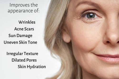 microneedling improves the appearance of: wrinkles, acne scars, sun damage, uneven skin tone, irregular texture, dilated pores, skin hydration