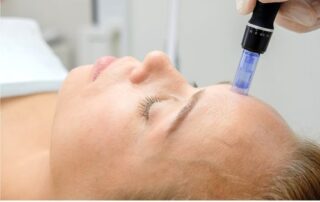 woman receiving microneedling treatment on forehead