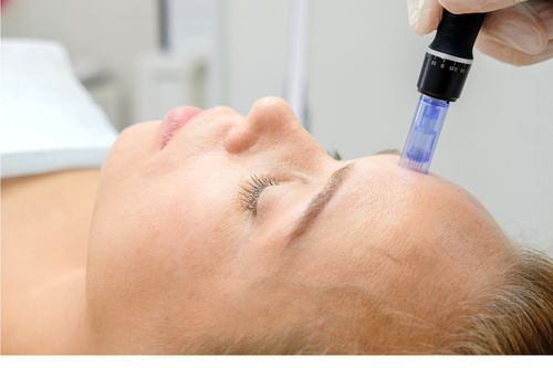 woman receiving microneedling treatment on forehead