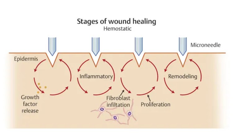 describes stages of wound healing and skin rejuvenation from microneedling treatment