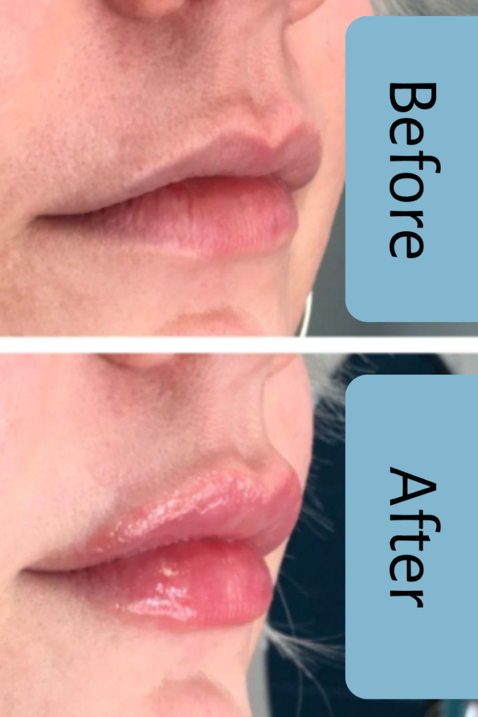 Lip Filler After Care Ageless Aesthetics & Natural Medicine