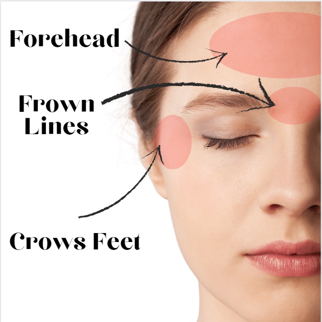 Close-up of a woman’s face with labeled areas. The forehead, frown lines, and crow’s feet are highlighted with red ovals and arrows. The text indicates common wrinkle locations. The woman’s eyes are closed, and she’s expressionless. Close-up of a woman's face with labeled areas. The forehead, frown lines, and crow's feet are highlighted with red ovals and arrows. The text indicates common wrinkle locations for receiving botox injections. The woman's eyes are closed, and she's expressionless.
