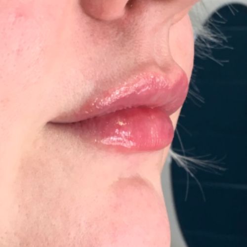 after photo of lip filler patient, from a 45 degree angle, showing increased lip volume and contouring.