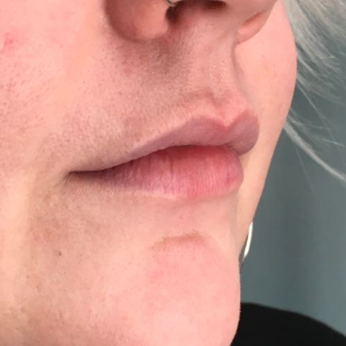 before photo of lip filler patient, from a 45 degree angle. She has a thin upper lip that can be volumized with filler treatment.