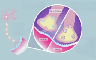 difference in nerve junction activity with botox treatment and without botox treatment