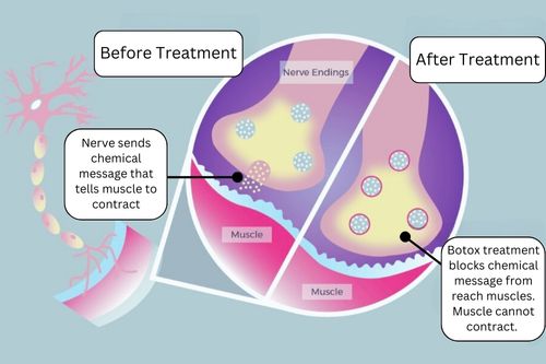 difference in nerve junction activity with botox treatment and without botox treatment with descriptive text