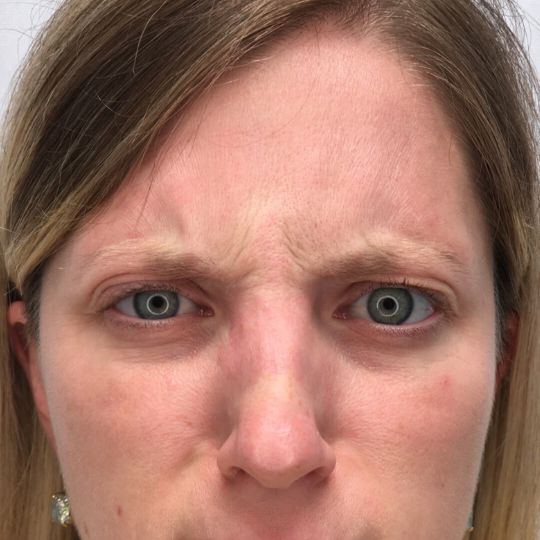 close up before photo of frown lines before getting botox treatment