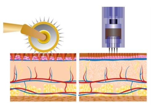 at-home microneedling roller creating conical gouges in the skin, compared to a professional microneedling pen creating clean well-defined vertical punctures.