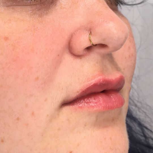 lip filler after photo in angle view
