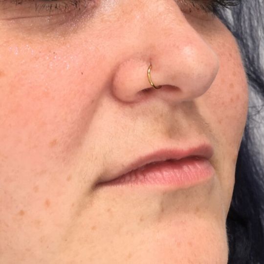 lip filler before photo in angle view