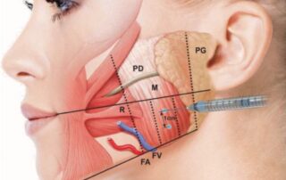 muscles involved in masseter botox injections