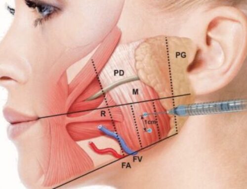 Masseter Muscle Botox Injections: Jawline Slimming Without Surgery