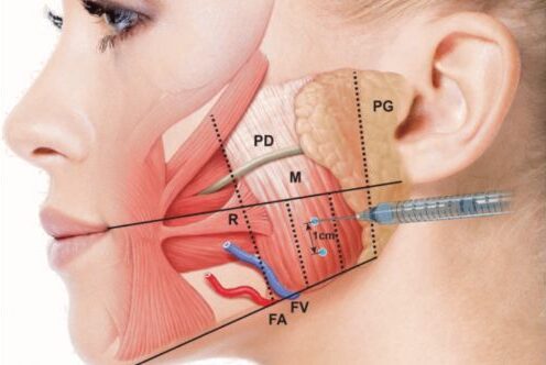 muscles involved in masseter botox injections