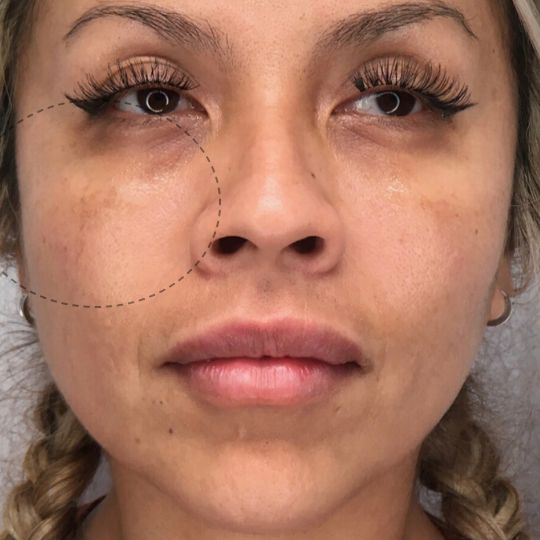 after photo of woman receiving cheek fillers showing increased volume in the cheeks, front view.