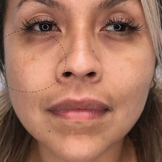 before photo of woman receiving cheek fillers showing decreased volume in the cheeks, front view