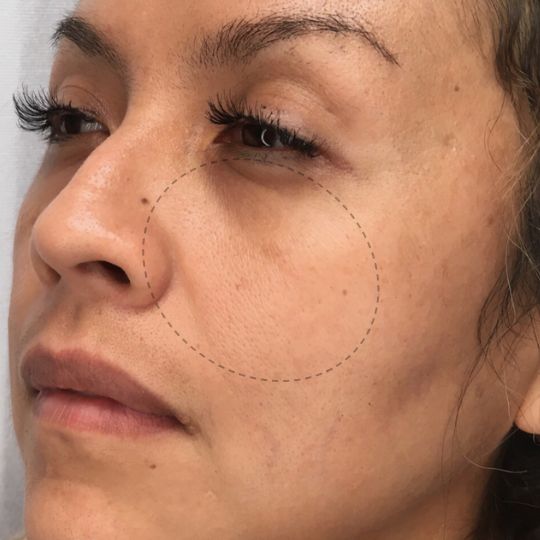 before photo of woman receiving cheek fillers showing decreased volume in the cheeks, angle view