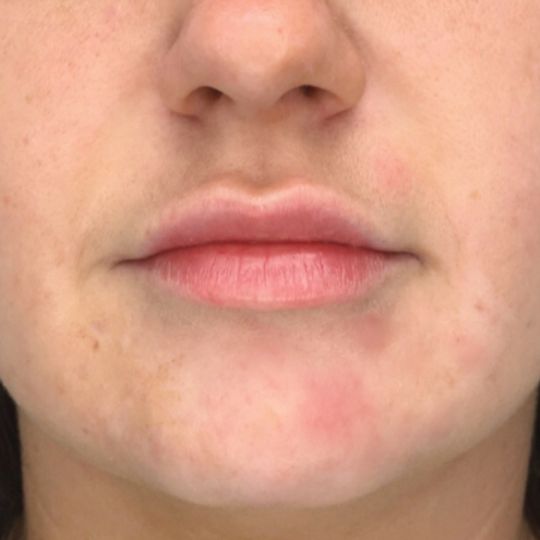 close in front view of after photo of lip filler treatment