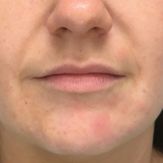 close in front view of before photo of lip filler treatment