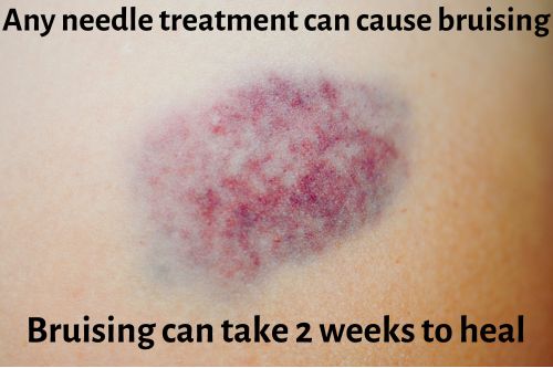 red and blue bruise on skin