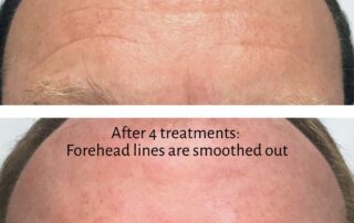 Forehead wrinkles before and after botox injections. The after photo shows significant improvement in the severity of forehead wrinkles.
