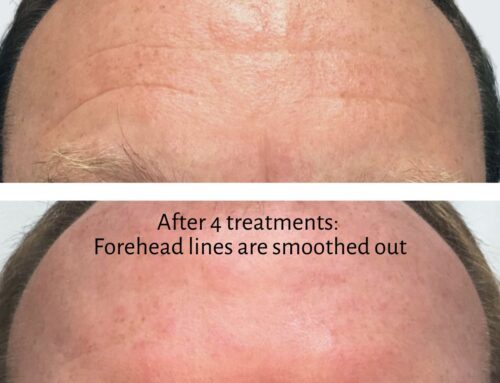 Can Botox treat deep forehead wrinkles? Yes! Here’s how.