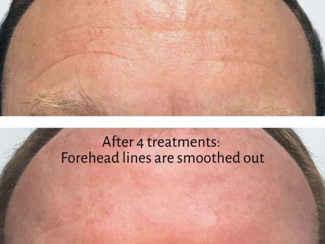 Can Botox treat deep forehead wrinkles? Yes! Here’s how.