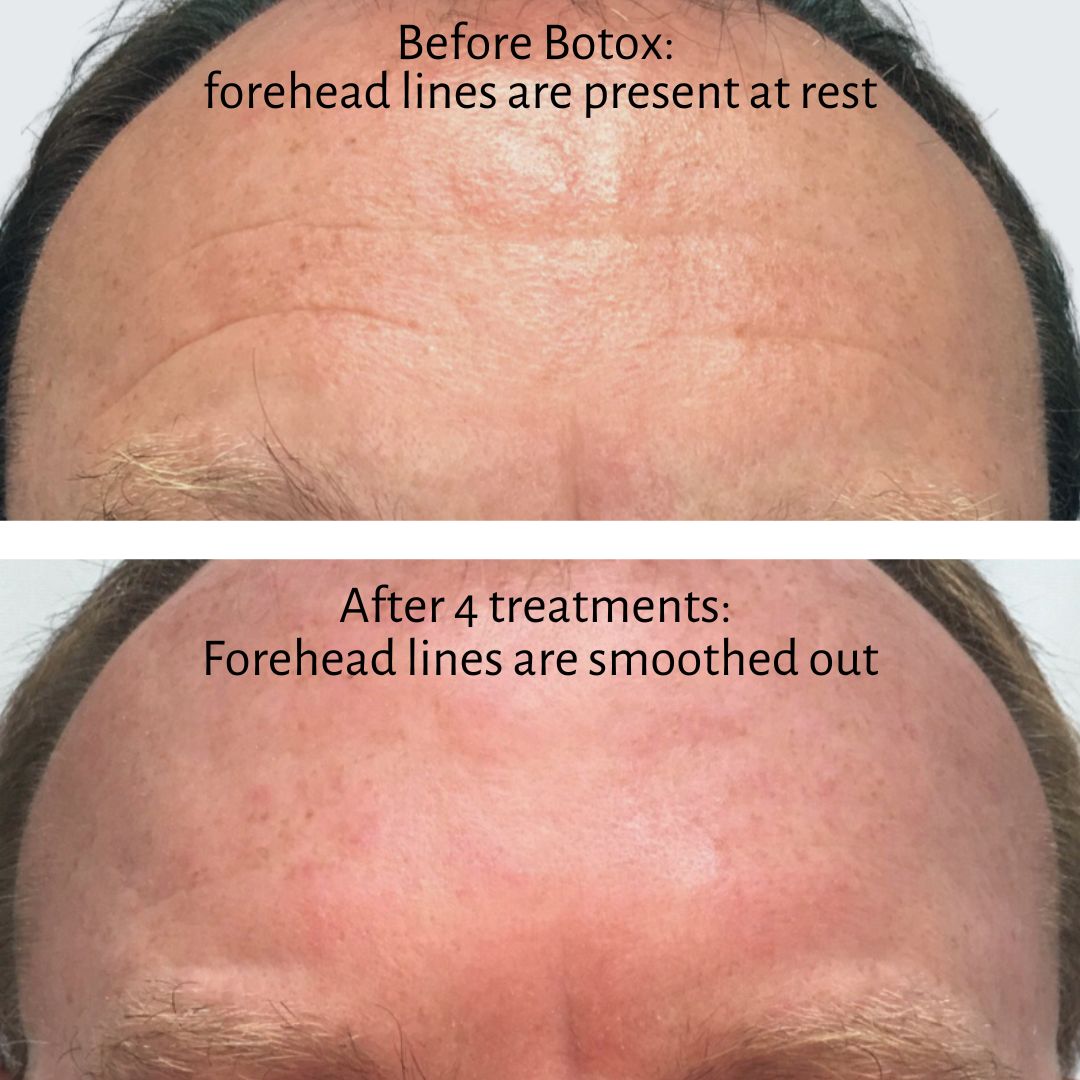 Forehead wrinkles before and after botox injections. The after photo shows significant improvement in the severity of forehead wrinkles.