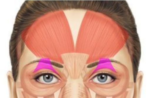 Highlights the location and activity of the Levator palpebrae superioris muscles that lifts the eyelids