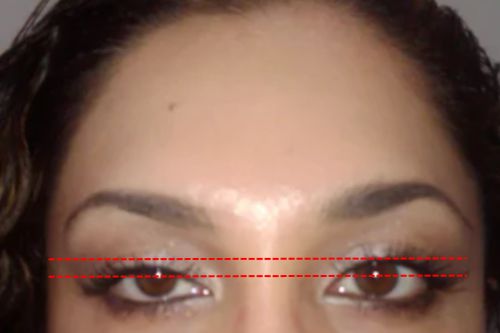 woman with moderate droopy eyelid from botox injections. A red line measures the severity of the ptosis.