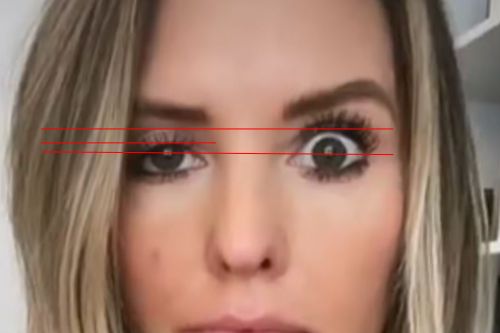 woman with severe droopy eyelid from botox injections. A red line measures the severity of the droopiness.