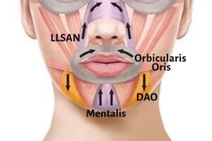 Anatomy chart of muscles of the lower face that can be treated with Botox injections for an aesthetically desirable effect.