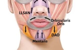 Anatomy chart of muscles of the lower face that can be treated with Botox injections for an aesthetically desirable effect.