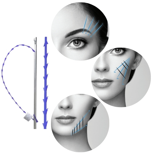 PDO Barbed Threads treatment areas Close-up of a barbed suture needle with a blue thread. The thread has tiny barbs along its length. Next to a grayscale illustration of a woman's face showing cosmetic procedure markings along the cheeks and jawline.