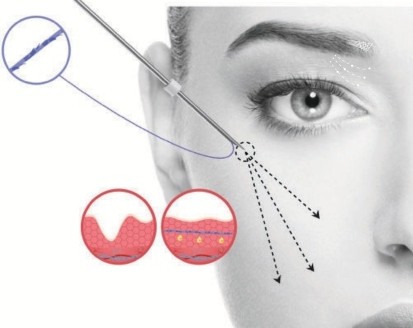 Graphic of lifting thread placed in the cheeks A grayscale diagram shows a woman's face with an illustration of a PDO thread used to lift the cheek. Inset diagrams depict the procedure's effect on skin layers. Arrows indicate the needle's insertion point and direction.