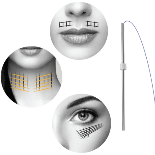 PDO Smooth Threads treatment areas A collage with facial areas highlighting cosmetic procedures: black and yellow grid lines on cheeks and under the lower lip, and a grid under the eye. A PDO lifting thread and needle is shown on the right.