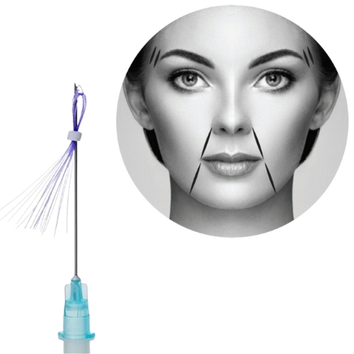 PDO multi thread treatment areas A needle with threads next to a grayscale illustration of a woman's face showing cosmetic procedure markings along the smile lines and temples.