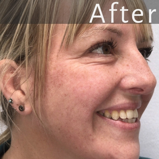 A close-up of a smiling woman’s face, showing her skin free of wrinkles. She has blonde hair and is wearing earrings. The word "AFTER" is written in large white letters at the top.