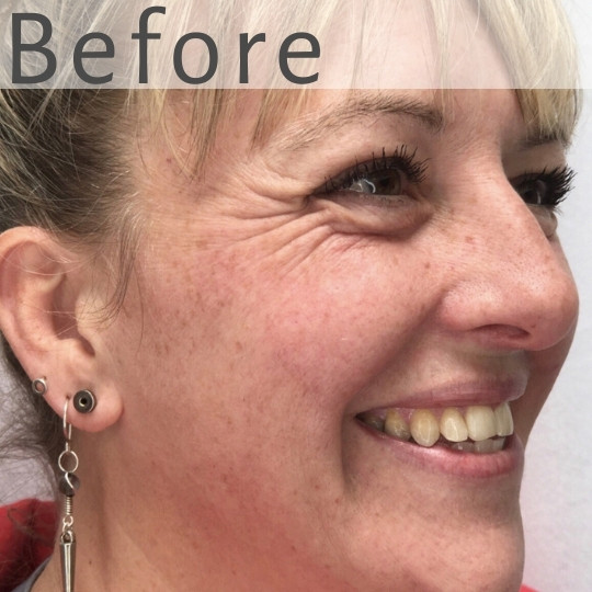 A smiling woman shown in close-up from the side, displaying visible wrinkles and crow's feet around her eye and cheek. The word "BEFORE" is written at the top of the image in large white letters.