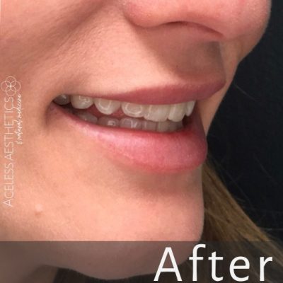 A close-up of a woman's smile featuring straight, white teeth and plump lips. The word "After" appears at the bottom, highlighting results of lip augmentation, with the Ageless Aesthetics logo on the left side.