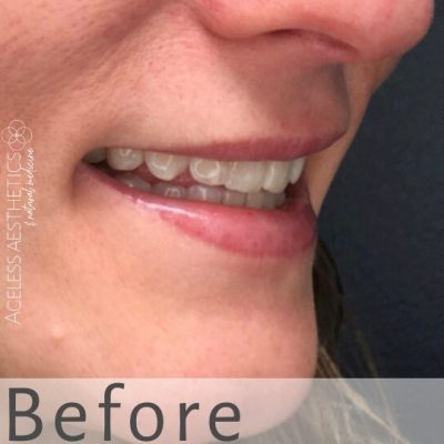 A close-up of a woman's face showing her smile before a cosmetic lip augmentation treatment. Her lips are slightly parted, revealing her teeth. The word "Before" is written at the bottom of the image.