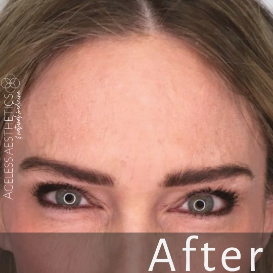 Close-up of a woman’s forehead and eyes, showing smooth skin and well-defined eyebrows. The word "After" appears at the bottom, indicating this is a post-treatment result. The Ageless Aesthetics logo is on the left side.