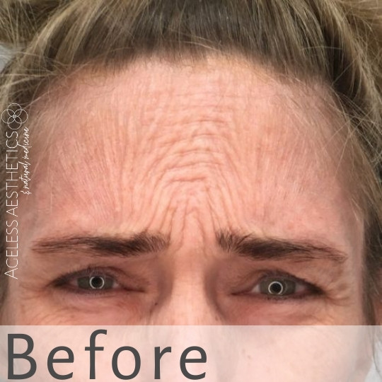 A close-up of a person’s forehead and eyes, showing prominent forehead wrinkles and frown lines, with the word “Before” overlaid at the bottom. The logo "Ageless Aesthetics" appears on the left side.