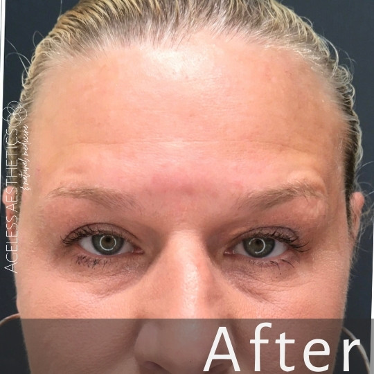 Close-up of a person's forehead and eyes after a cosmetic procedure, showing smooth, clear skin with reduced wrinkles. The word "After" is overlaid at the bottom, indicating the post-treatment result.