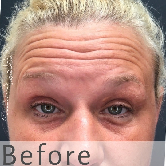 Close-up of a person's forehead and eyes showing visible horizontal forehead wrinkles. The skin appears textured, and the person's blonde hair is pulled back. The word "Before" is displayed at the bottom of the image.