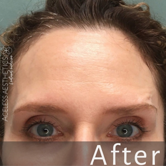 Close-up of a person's forehead and eyes with smooth, clear skin. The image has the word “After” at the bottom, suggesting a cosmetic or skincare treatment result. “Ageless Aesthetics” is displayed on the left side.