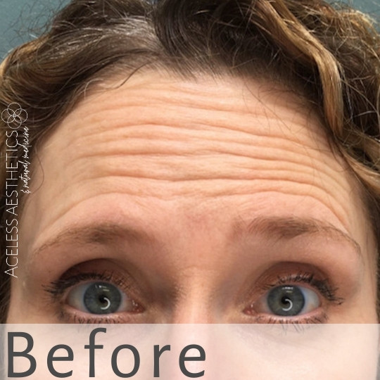 Close-up of a person's forehead and eyes. The forehead shows multiple horizontal wrinkles. The person has light skin, blue-green eyes, and wavy brown hair. The word "Before" is written at the bottom of the image.