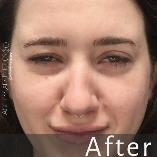 A close-up of a woman's face showing her smooth skin and even texture. She has a small gold nose ring and neutral expression. The word "After" is displayed at the bottom, with a logo on the left reading "Ageless Aesthetics.