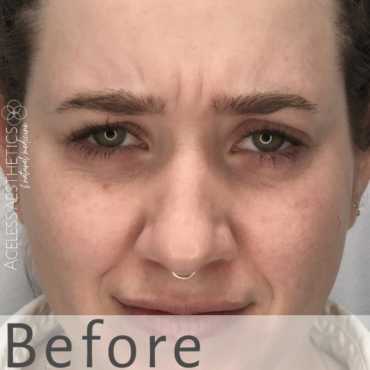 A woman with light skin and green eyes frowns, showing vertical wrinkles between her eyebrows. She has a nose ring. The text "Before" is overlaid at the bottom of the image.